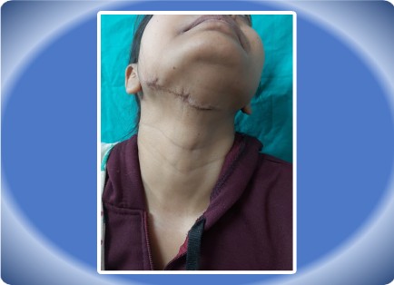 SCAR FACE
